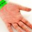 Latex Allergy
